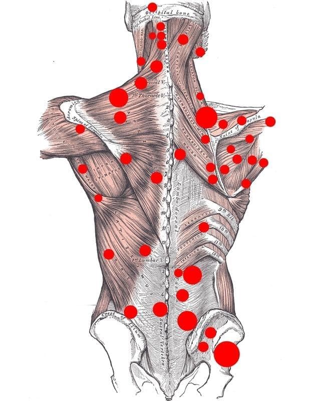 Trigger points mapa.